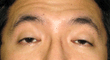 眼瞼下垂